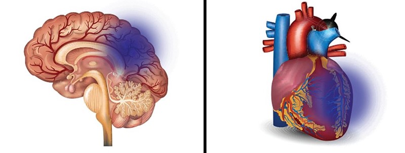 Dva vaskularna stanja koja su usko vezana uz hipertenziju, a vodeći su uzrok smrtnosti u razvijenom svijetu: moždani udari i srčani infarkt