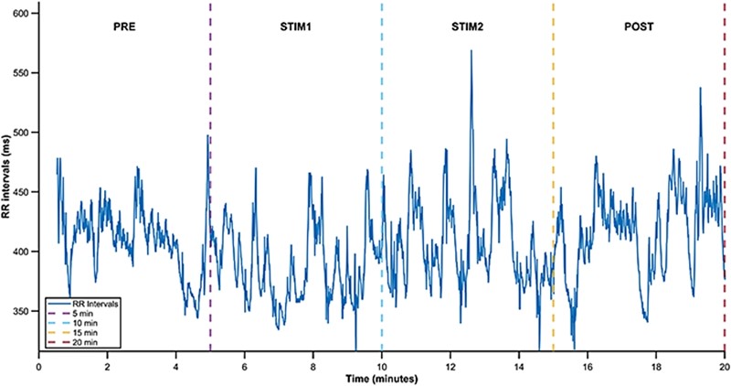 Grafikon ilustrira fluktuacije fetalnih intervala tijekom snimanja: PRE je razdoblje prije glazbene stimulacije, STIM1 označava stimulaciju prvom pjesmom, STIM2 drugom, a POST razdoblje nakon glazbene stimulacije 📷 Claudia Lerma i sur.
