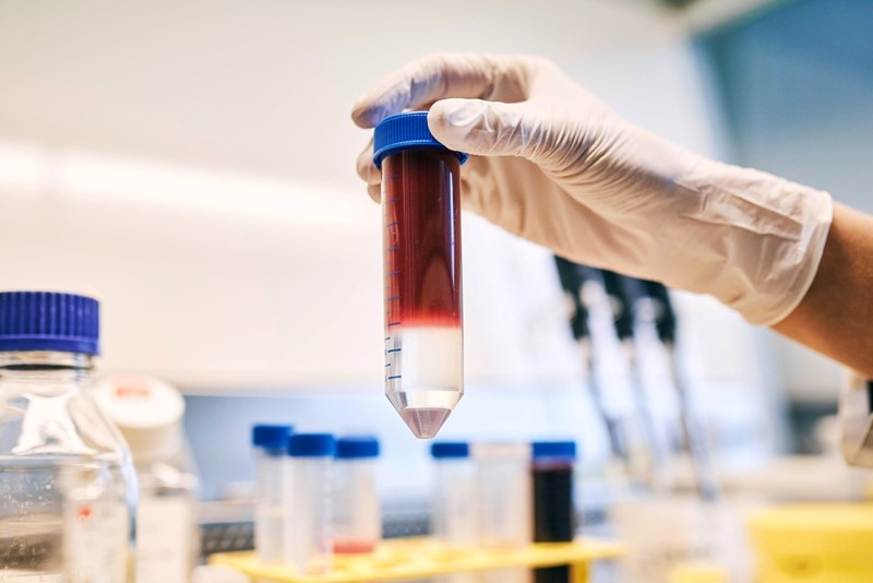 U adaptivnoj terapiji T-stanicama pacijentove vlastite imunološke stanice izoliraju se iz krvi, modificiraju i umnožavaju u laboratoriju i zatim ponovno unose u pacijenta kako bi uništavale tumorske stanice    📷 Anna Schroll/Leibniz-HKI