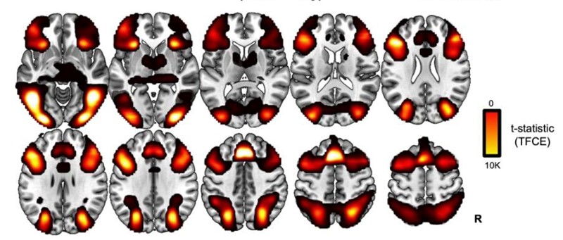 Obrasci moždane aktivnosti istraživani su pomoću skenova funkcionalne magnetske rezonancije i strojnog učenja 📷  University of Cambridge
