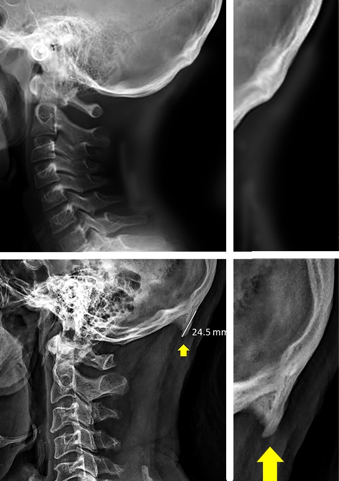Gornji red slika: normalan Rtg stražnjeg dijela lubanje (uvećan detalj: malen, pravilan POE). Donji red: Rtg snimka kronično opterećene lubanje (uvećan detalj: koštani 'rog' koji izrasta iz POE)