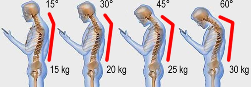 Patološka hiperfleksija, nepravilno držanje glave prema naprijed, opterećuje mišiće vrata i njihovo hvatište na zatiljnoj kosti srazmjerno kutu pod kojim dolazi do zatezanja: što 'grbavije' držimo glavu, veće je kronično opterećenje