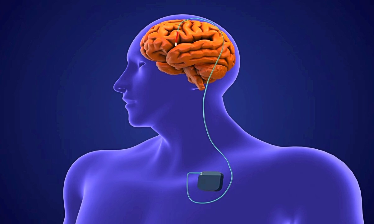 Velika multicentrična studija britanskih institucija koristi duboku moždanu stimulaciju za liječenje žudnje i recidiva teške ovisnosti 📷 Brain-PACER