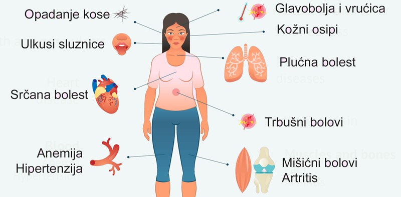 Najčešći simptomi sistemskog lupusa
