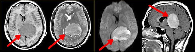 Benigni tumori mozga - premda po definiciji nisu agresivni - mogu stvarati vrlo teške kliničke slike upravo zbog svoje veličine i pritiska na okolne moždane strukture 📷 WikMedia / Doc