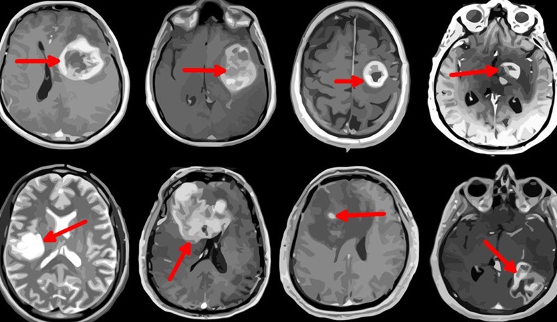 Serija MR-snimki različitih pacijenata na kojima su markirani agresivni, maligni tumori mozga 📷 Doc/Ai