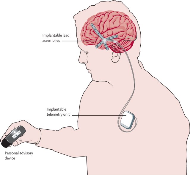 Shematski prikaz ugrađenog Neurovista BCI-uređaja: elektrode implantirane u mozgu detektiraju signale nadolazećeg epileptičkog napadaja, o čemu uređaj prosljeđuje notifikaciju pacijenta na specijalni pager