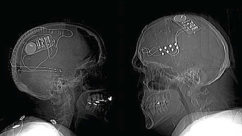 Radiološke snimke pozicije računalno kontroliranih moždanih neurostimulirajućih implantata (sučelja mozga-računalo) kod dvaju pacijenata