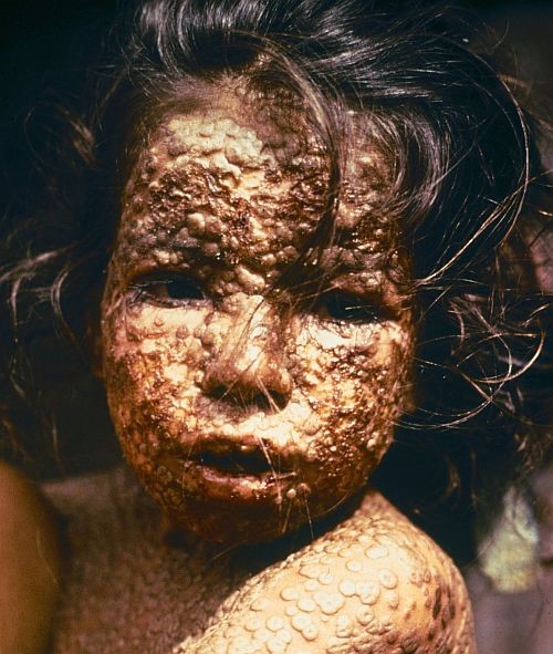 Lice djeteta oboljelog od velikih boginja (variola vera)