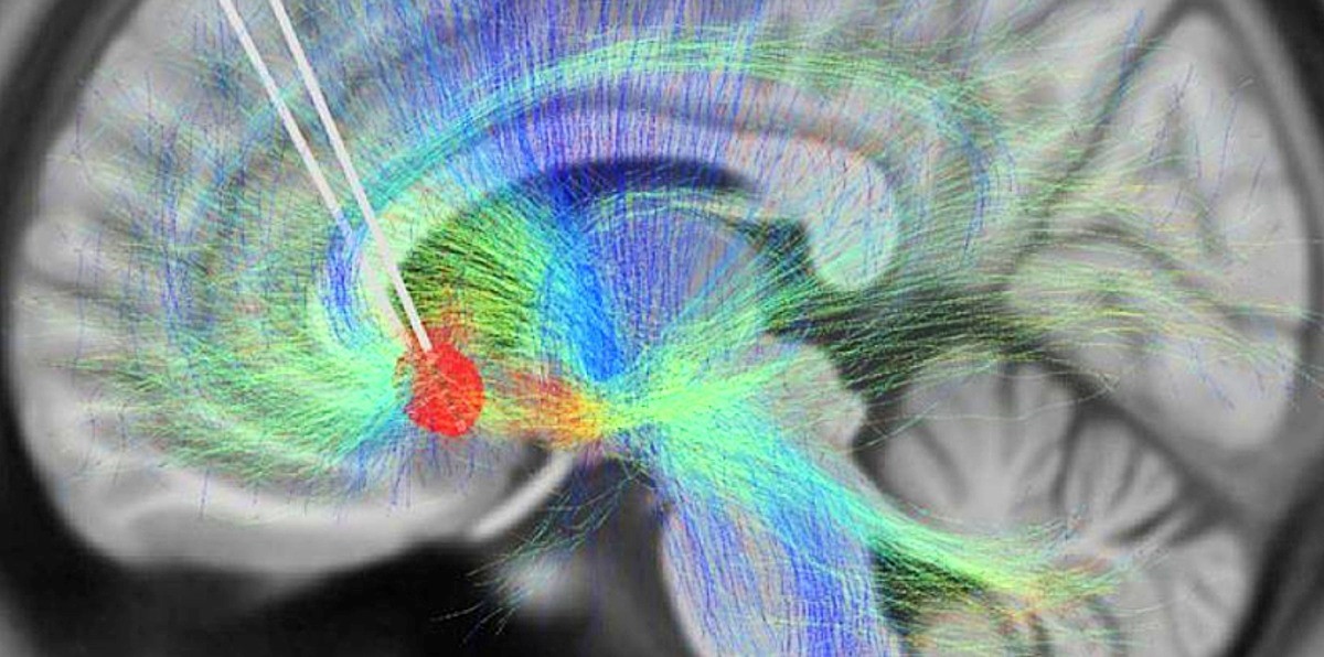 Za praćenje moždanih uzoraka korišteni su elektrodni implantati 📷 Ki Seung Choi/Mayberg lab, Icahn School of Medicine at Mount Sinai